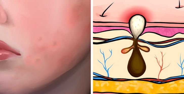 Papules